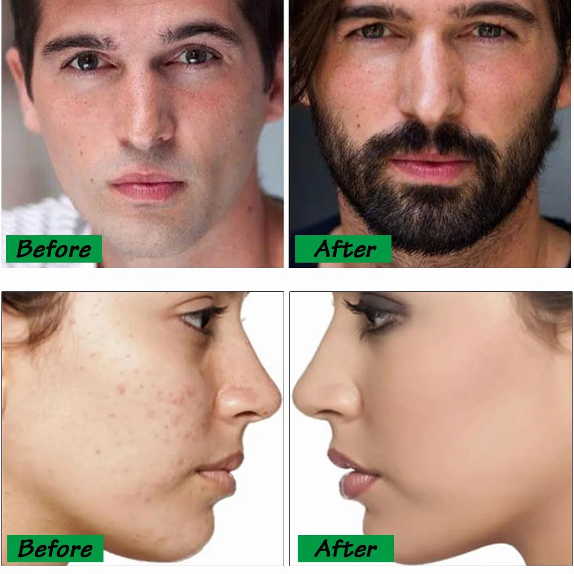 Microneedling Roller do odrastania włosów, rolka brody, 540 tytanowych igieł 0,5 mm, wałek do brody do stymulacji odrastania włosów/wzrostu brody